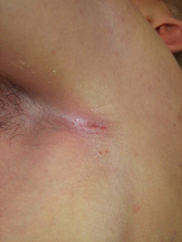 Axilla